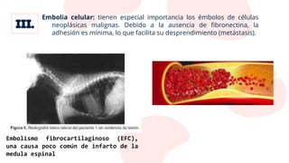 Embolia celular: tienen especial importancia los émbolos de células
neoplásicas malignas. Debido a la ausencia de fibronectina, la
adhesión es mínima, lo que facilita su desprendimiento (metástasis).
Embolismo fibrocartilaginoso (EFC),
una causa poco común de infarto de la
medula espinal
 