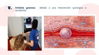 Embolia gaseosa: debido a una intervención quirúrgica o
accidentes.
 