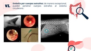 Embolia por cuerpos extraños: de manera excepcional,
pueden penetrar cuerpos extraños al sistema
circulatorio.
 