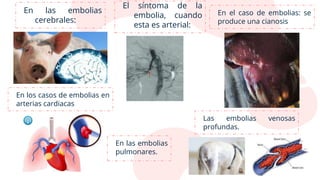 En las embolias
cerebrales:
El síntoma de la
embolia, cuando
esta es arterial:
En el caso de embolias: se
produce una cianosis
En los casos de embolias en
arterias cardiacas
En las embolias
pulmonares.
Las embolias venosas
profundas.
 