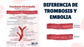 DIFERENCIA DE
TROMBOSIS Y
EMBOLIA
 