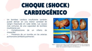 CHOQUE (SHOCK)
CARDIOGÉNICO
 