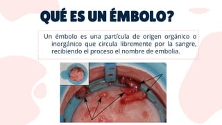 QUÉ ES UN ÉMBOLO?
 