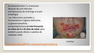 Glomerulonefritis postestreptocócica
 Se presenta entre 1 y 4 semanas
después de una infección
estreptocócica de la faringe o la piel
(impétigo).
 Las infecciones asociadas a
hacinamiento e higiene deficiente.
 La glomerulonefritis
postestreptocócica es más frecuente
en niños de 6 a 10 años de edad, pero
también puede afectar a adultos de
cualquier edad.
impétigo
 