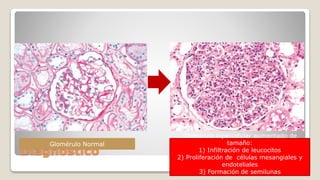 Diagnóstico
Glomérulo Normal
Glomérulo hipercelular aumentado de
tamaño:
1) Infiltración de leucocitos
2) Proliferación de células mesangiales y
endoteliales
3) Formación de semilunas
 