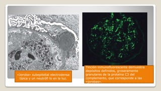 «Joroba» subepitelial electrodensa
típica y un neutrófi lo en la luz.
Tinción inmunofluorescente demuestra
depósitos definidos, groseramente
granulares de la proteína C3 del
complemento, que corresponde a las
«jorobas».
 