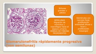 Glomerulonefritis rápidamente progresiva
(con semilunas)
Riñones
grandes y
pálidos
Glomérulos con
necrosis focal,
proliferación
endoteliall difusa o
focal y
proliferación
mesangial
SEMILUNAS
Migración de
monicitos y
macrófagos hacia el
espacio urinario.
HEBRAS DE FIBRINA
PROMINENTES
 