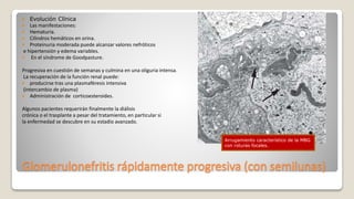 Glomerulonefritis rápidamente progresiva (con semilunas)
 Evolución Clínica
 Las manifestaciones:
 Hematuria.
 Cilindros hemáticos en orina.
 Proteinuria moderada puede alcanzar valores nefróticos
e hipertensión y edema variables.
 En el síndrome de Goodpasture.
Progresiva en cuestión de semanas y culmina en una oliguria intensa.
La recuperación de la función renal puede:
 producirse tras una plasmaféresis intensiva
(intercambio de plasma)
 Administración de corticoesteroides.
Algunos pacientes requerirán finalmente la diálisis
crónica o el trasplante a pesar del tratamiento, en particular si
la enfermedad se descubre en su estadio avanzado.
Arrugamiento característico de la MBG
con roturas focales.
 