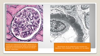 Tinción con metenamina de plata. Obsérvese el
importante engrosamiento difuso de las paredes
capilares sin incremento del número de células.
Existen «espículas».
Borramiento de los podocitos que recubren los
depósitos. End, endotelio; Ep, epitelio; LC, luz capilar.
 