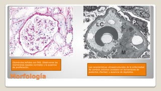 Morfología
Glomérulos teñidos con PAS. Obsérvense las
membranas basales normales y la ausencia
de proliferación. Las características ultraestructurales de la enfermedad
de cambios mínimos consisten en borramiento de
podocitos (flechas) y ausencia de depósitos.
 