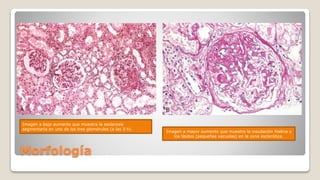 Morfología
Imagen a bajo aumento que muestra la esclerosis
segmentaria en uno de los tres glomérulos (a las 3 h).
Imagen a mayor aumento que muestra la insudación hialina y
los lípidos (pequeñas vacuolas) en la zona esclerótica.
 
