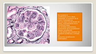 Se muestra la
proliferación de la célula
mesangial, el aumento de la
matriz mesangial (se
tiñe de negro con la tinción de
plata), engrosamiento de la
membrana basal
con división segmentaria,
acentuación de la arquitectura
lobular, tumefacción
de las células que recubren los
capilares periféricos y entrada
de
leucocitos (proliferación
endocapilar).
 