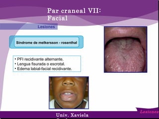 Síndrome de melkersson - rosenthal
Par craneal VII:
Facial
Lesiones
Lesiones
• PFI recidivante alternante.
• Lengua fisurada o escrotal.
• Edema labial-facial recidivante.
Univ. Xaviela
 