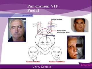 Par craneal VII:
Facial
Lesiones
Lesiones
Univ. Xaviela
 