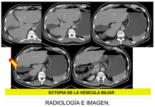 ECTOPIA DE LA VESICULA BILIAR

RADIOLOGÍA E IMAGEN.

 