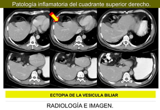 Patología inflamatoria del cuadrante superior derecho.

ECTOPIA DE LA VESICULA BILIAR

RADIOLOGÍA E IMAGEN.

 