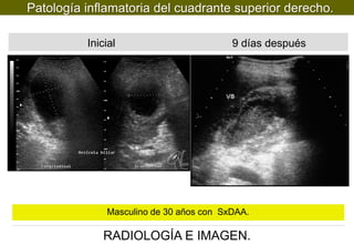 Patología inflamatoria del cuadrante superior derecho.
Inicial

9 días después

Masculino de 30 años con SxDAA.

RADIOLOGÍA E IMAGEN.

 
