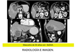 Masculino de 30 años con SxDAA.

RADIOLOGÍA E IMAGEN.

 