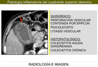 Patología inflamatoria del cuadrante superior derecho.

QUIRÚRGICO:
PERFORACIÓN VESICULAR
CONTENIDA POR EPIPLON
PIOCOLECISTO
LITIASIS VESICULAR
HISTOPATOLÓGICO:
COLECISTITIS AGUDA
GANGRENADA
COLECISTITIS CRÓNICA

RADIOLOGÍA E IMAGEN.

 