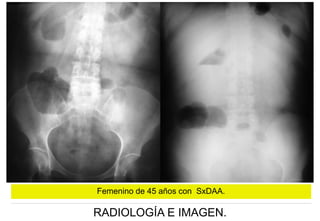 Femenino de 45 años con SxDAA.

RADIOLOGÍA E IMAGEN.

 