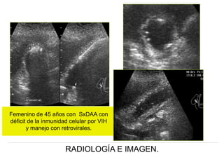 Femenino de 45 años con SxDAA con
déficit de la inmunidad celular por VIH
y manejo con retrovirales.

RADIOLOGÍA E IMAGEN.

 