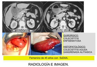QUIRÚRGICO:
COLECISTITIS
ENFISEMATOSA
HISTOPATOLÓGICO:
COLECISTITIS AGUDA
GANGRENADA ALITIASICA

Femenino de 45 años con SxDAA.

RADIOLOGÍA E IMAGEN.

 