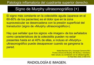 Patología inflamatoria del cuadrante superior derecho.

Signo de Murphy ultrasonográfico (+)
El signo más constante en la colecistitis aguda (aparece en el
60-80% de los pacientes) es el dolor que en la zona
supravesicular se desencadena con la presión superficial del
transductor (signo de «Murphy ultrasonográfico»).
Hay que señalar que los signos «de imagen» de los señalados
como característicos de la colecistitis pueden no estar
presentes hasta en el 40% de ellas, e incluso el «Murphy»
ultrasonográfico puede desaparecer cuando se gangrena la
pared.
Motta-Ramírez GA y Uscanga-Carmona MA.
Puntos clínicos de Murphy, Mc Burney y Giordano:
Valor actual y su correlación con la Ultrasonografía .
An Rad Mex 2002; 2:409-416.

RADIOLOGÍA E IMAGEN.

 