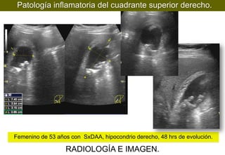 Patología inflamatoria del cuadrante superior derecho.

Femenino de 53 años con SxDAA, hipocondrio derecho, 48 hrs de evolución.

RADIOLOGÍA E IMAGEN.

 