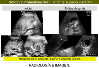 Patología inflamatoria del cuadrante superior derecho.
Inicial

6 días después

Masculino de 17 años con SxDAA y síndrome ictérico.

RADIOLOGÍA E IMAGEN.

 