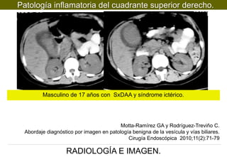 Patología inflamatoria del cuadrante superior derecho.

Masculino de 17 años con SxDAA y síndrome ictérico.

Motta-Ramírez GA y Rodríguez-Treviño C.
Abordaje diagnóstico por imagen en patología benigna de la vesícula y vías biliares.
Cirugía Endoscópica 2010;11(2):71-79

RADIOLOGÍA E IMAGEN.

 
