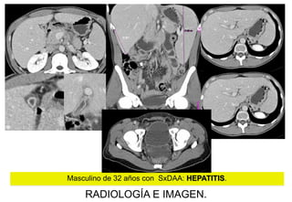 Masculino de 32 años con SxDAA: HEPATITIS.

RADIOLOGÍA E IMAGEN.

 