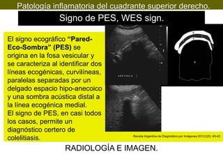 Patología inflamatoria del cuadrante superior derecho.

Signo de PES, WES sign.
El signo ecográfico “ParedEco-Sombra” (PES) se
origina en la fosa vesicular y
se caracteriza al identificar dos
líneas ecogénicas, curvilíneas,
paralelas separadas por un
delgado espacio hipo-anecoico
y una sombra acústica distal a
la línea ecogénica medial.
El signo de PES, en casi todos
los casos, permite un
diagnóstico certero de
colelitiasis.

Revista Argentina de Diagnóstico por Imágenes 2013;2(5) :40-42.

RADIOLOGÍA E IMAGEN.

 