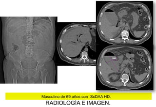 Masculino de 69 años con SxDAA HD.

RADIOLOGÍA E IMAGEN.

 