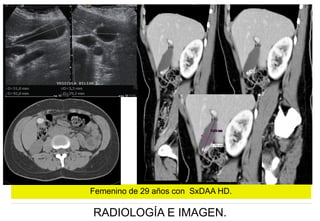 Femenino de 29 años con SxDAA HD.

RADIOLOGÍA E IMAGEN.

 