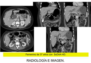 Femenino de 37 años con SxDAA HD.

RADIOLOGÍA E IMAGEN.

 