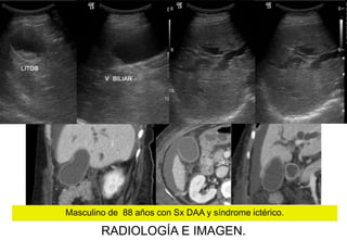 Masculino de 88 años con Sx DAA y síndrome ictérico.

RADIOLOGÍA E IMAGEN.

 