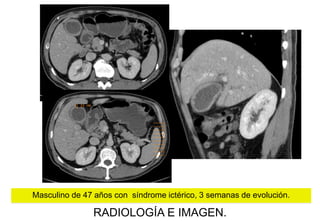 Masculino de 47 años con síndrome ictérico, 3 semanas de evolución.

RADIOLOGÍA E IMAGEN.

 