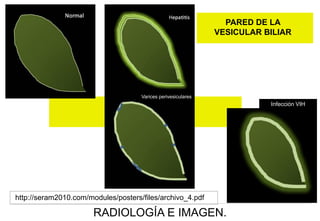 PARED DE LA
VESICULAR BILIAR

Varices perivesiculares

Infección VIH

http://seram2010.com/modules/posters/files/archivo_4.pdf

RADIOLOGÍA E IMAGEN.

 