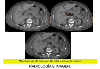 Masculino de 88 años con Sx DAA y síndrome ictérico.

RADIOLOGÍA E IMAGEN.

 