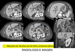 Masculino de 88 años con Sx DAA y síndrome ictérico.

RADIOLOGÍA E IMAGEN.

 