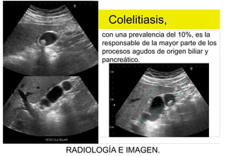Colelitiasis,
con una prevalencia del 10%, es la
responsable de la mayor parte de los
procesos agudos de origen biliar y
pancreático.

RADIOLOGÍA E IMAGEN.

 