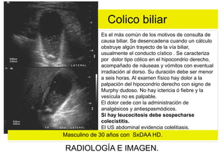 Colico biliar
Es el más común de los motivos de consulta de
causa biliar. Se desencadena cuando un cálculo
obstruye algún trayecto de la vía biliar,
usualmente el conducto cístico . Se caracteriza
por dolor tipo cólico en el hipocondrio derecho,
acompañado de náuseas y vómitos con eventual
irradiación al dorso. Su duración debe ser menor
a seis horas. Al examen físico hay dolor a la
palpación del hipocondrio derecho con signo de
Murphy dudoso. No hay ictericia ó fiebre y la
vesícula no es palpable.
El dolor cede con la administración de
analgésicos y antiespasmódicos.
Si hay leucocitosis debe sospecharse
colecistitis.
El US abdominal evidencia colelitiasis.

Masculino de 30 años con SxDAA HD.

RADIOLOGÍA E IMAGEN.

 