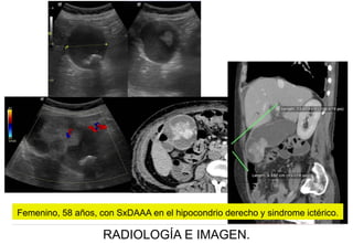 Femenino, 58 años, con SxDAAA en el hipocondrio derecho y sindrome ictérico.

RADIOLOGÍA E IMAGEN.

 