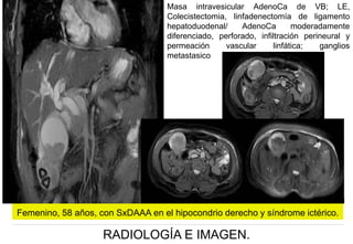 Masa intravesicular AdenoCa de VB; LE,
Colecistectomia, linfadenectomía de ligamento
hepatoduodenal/
AdenoCa
moderadamente
diferenciado, perforado, infiltración perineural y
permeación
vascular
linfática;
ganglios
metastasico

Femenino, 58 años, con SxDAAA en el hipocondrio derecho y síndrome ictérico.

RADIOLOGÍA E IMAGEN.

 