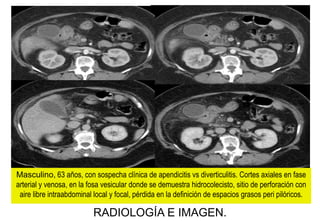 Masculino, 63 años, con sospecha clínica de apendicitis vs diverticulitis. Cortes axiales en fase
arterial y venosa, en la fosa vesicular donde se demuestra hidrocolecisto, sitio de perforación con
aire libre intraabdominal local y focal, pérdida en la definición de espacios grasos peri pilóricos.

RADIOLOGÍA E IMAGEN.

 