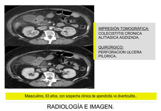 IMPRESIÓN TOMOGRÁFICA:
COLECISTITIS CRONICA
ALITIASICA AGDIZADA.
QUIRÚRGICO:
PERFORACION ULCERA
PILORICA.

Masculino, 63 años, con sospecha clínica de apendicitis vs diverticulitis..

RADIOLOGÍA E IMAGEN.

 