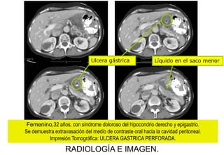 Ulcera gástrica

Líquido en el saco menor

Femenino,32 años, con síndrome doloroso del hipocondrio derecho y epigastrio.
Se demuestra extravasación del medio de contraste oral hacia la cavidad peritoneal.
Impresión Tomográfica: ULCERA GASTRICA PERFORADA.

RADIOLOGÍA E IMAGEN.

 
