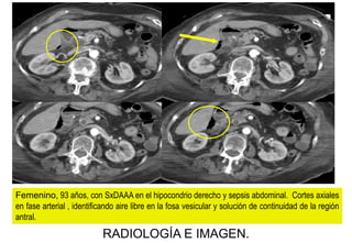 Femenino, 93 años, con SxDAAA en el hipocondrio derecho y sepsis abdominal. Cortes axiales
en fase arterial , identificando aire libre en la fosa vesicular y solución de continuidad de la región
antral.

RADIOLOGÍA E IMAGEN.

 