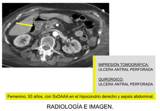 IMPRESIÓN TOMOGRÁFICA:
ULCERA ANTRAL PERFORADA
QUIRÚRGICO:
ULCERA ANTRAL PERFORADA

Femenino, 93 años, con SxDAAA en el hipocondrio derecho y sepsis abdominal.

RADIOLOGÍA E IMAGEN.

 