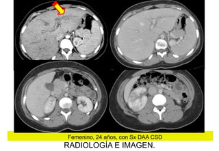 Femenino, 24 años, con Sx DAA CSD

RADIOLOGÍA E IMAGEN.

 